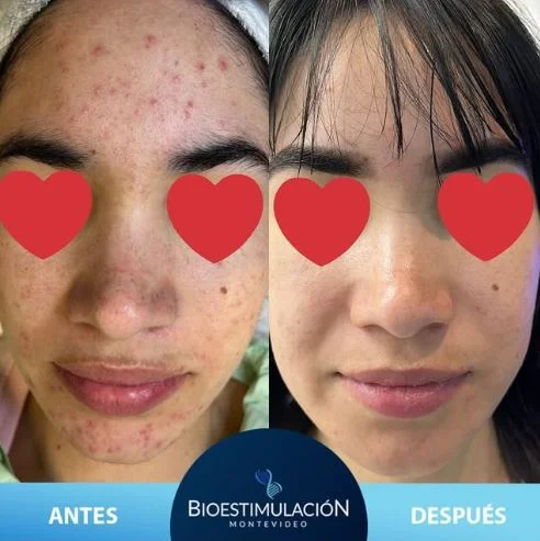 Resultado de tratamiento de cicatrices - Bioestimulación