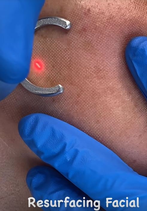 Resultado de piel renovada - Bioestimulación