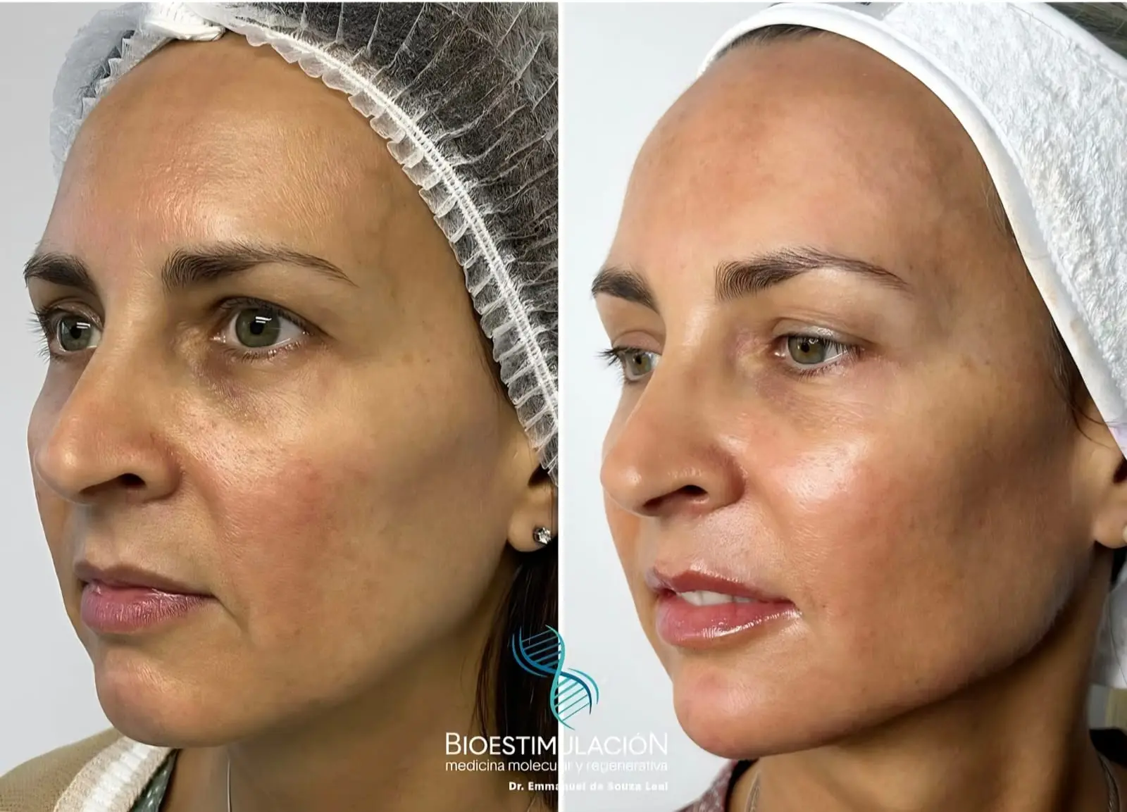 Tratamiento de estética facial en Montevideo – Bioestimulación