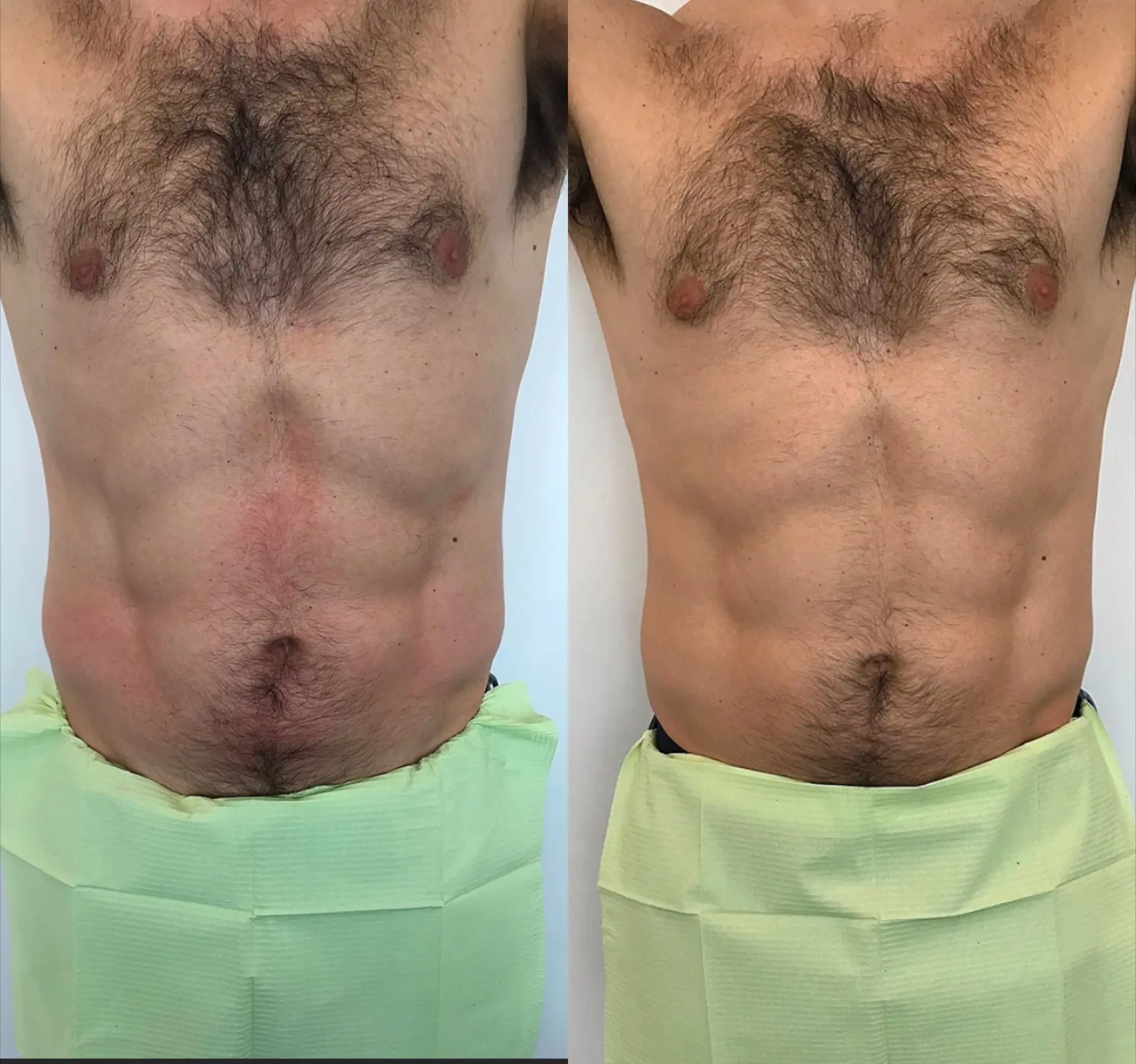 Tratamiento Biosculpt - Bioestimulación