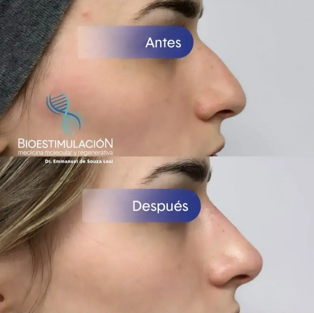 Tratamiento de Rinomodelación femenina - Bioestimulación