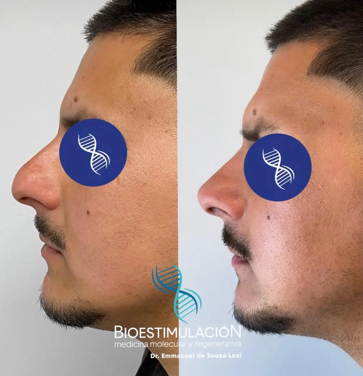 Resultado de rinomodelación masculina - Bioestimulación