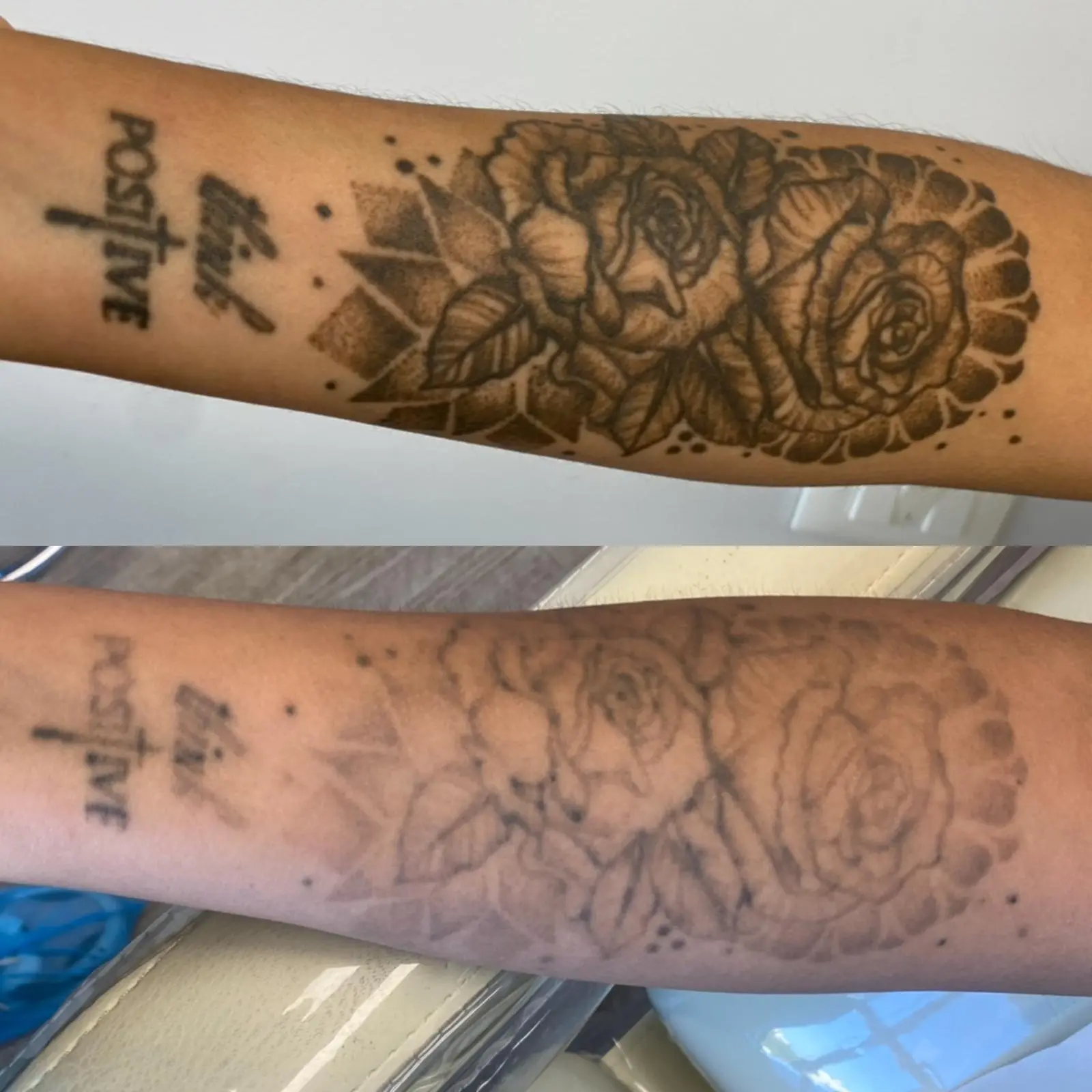 Remoción de Tatuajes - Bioestimulación