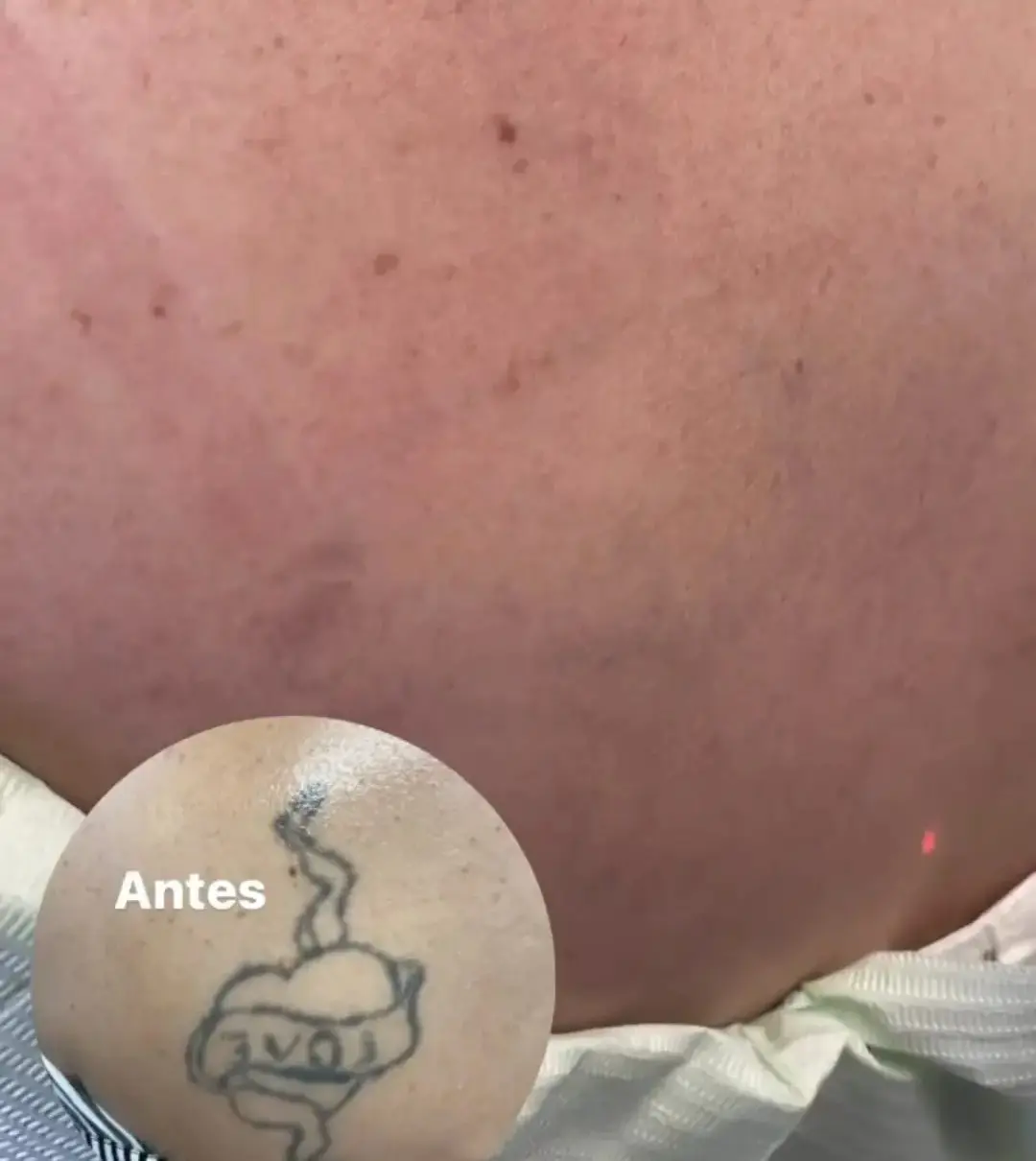 Remoción de Tatuajes - Bioestimulación